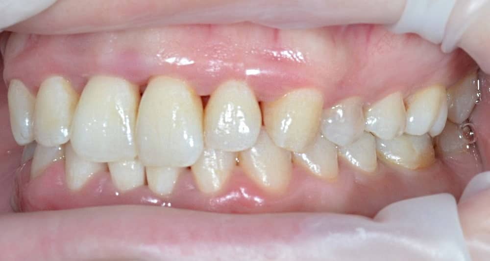 зубы после лечения