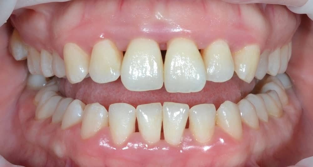 результат лечения зубов