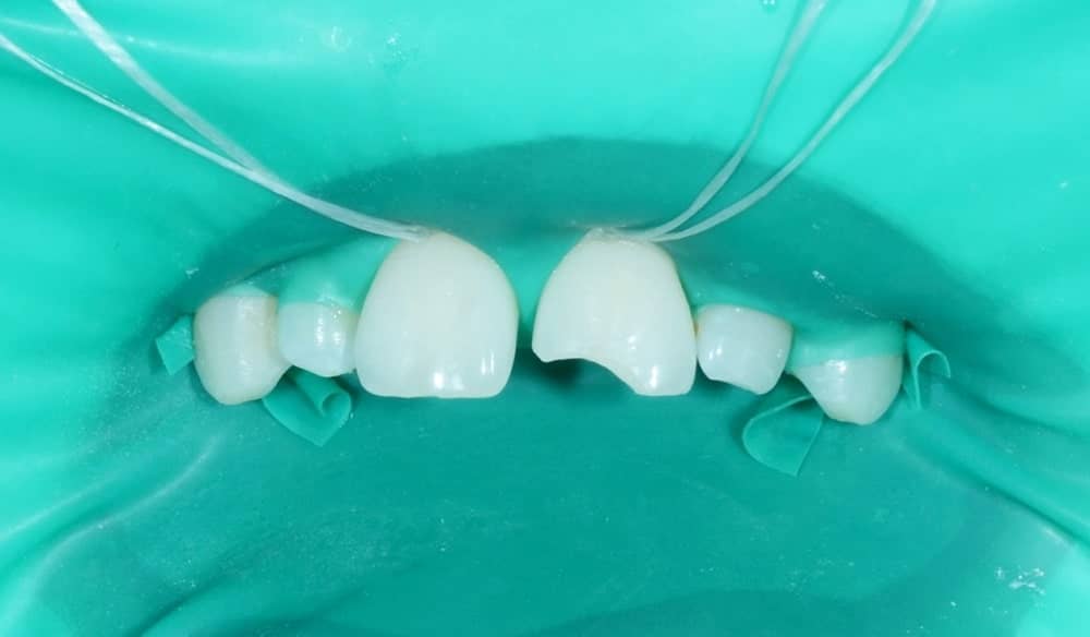 реставрація осколка зуба